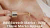  Red Stretch Marks Why These Marks Appear - DGS Health  