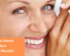 Reducing Smile Lines With Botox &amp; Fillers