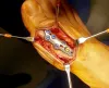 Do you Know About Removal of Orthopedic Implant?