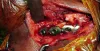 Removal of Surgical Orthopedic Implants, Indications of Implant Removal