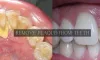 How To Remove Plaque From Teeth? Causes &amp; Preventive Measures - TEN
