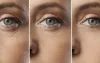 microneedling with radiofrequency
