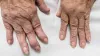 What is the Ayurvedic and Panchakarma Treatment of Rheumatoid Arthritis?  |