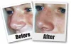 Seattle Rhinoplasty Seattle | Rhinoplasty Cost | Seattle Plastic Surgery