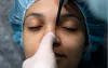 Rhinoplasty Swelling Stages & Recovery