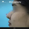 Rhinoplasty Doctor in Hyderabad