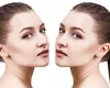 Rhinoplasty Recovery Tips