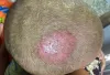 Best Scalp Infections Treatment in Bangalore - Dr. Health Hair Clinic