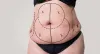 Tummy Tuck Surgery in Delhi