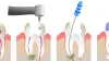 Jeffreylinda | What is a Root Canal Procedure?