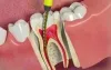 Treat the infected tooth with root canal