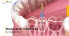 Best Root Canal Treatment in Gurgaon