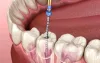 Root Canal Treatment in Kolkata: Debunking Myths and Embracing Modern Techniques | Healthworkoutplan.com