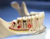 Root Canal Treatment