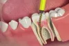 Root Canal Treatment