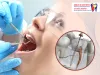 Is Root Canal Treatment Painful? Know Here
