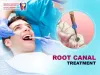 Things You Should Know About Root Canal Treatment