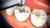 Root Canal Treatment in Islamabad, Pakistan