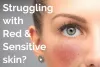 This Is Why We Recommend Lasers for Rosacea Treatment - You By Sia