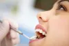 What is wisdom tooth removal