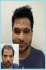 Hair Weaving in Gurgaon | No.1 Hair Weaving Centre in Gurgaon