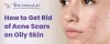 How to Get Rid off Acne Scars on Oily Skin - Acne Scar Treatment