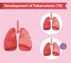 TB Specialist in Aurangabad- Subhashree Hospital