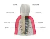 Dental Implants in The Woodlands &; Conroe, TX | PCE