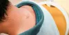 Sebaceous Cyst Wound Healing Time
