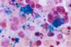 Best Bone Marrow Transplant Surgeons in India