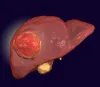 Liver Cancer Treatment in Mumbai