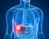 Colorectal Cancer Treatment in Mumbai