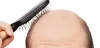 Hair Transplant Treatment in Chennai | Raj Cosmeticsurgery