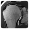 Everything you need to know about Shoulder Surgery 