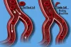 Sickle Cell Diseases - Its Symptoms &amp; Treatment | My Bonemarrow-transplant blog