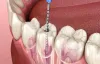 Exploring the Benefits of Single Sitting RCT Treatment