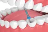 Root Canal Treatment in Kolkata