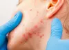 Skin Allergies - Diagnosis and Treatment