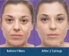 Fillers Treatment Delhi,India,Skin Fillers Treatment Delhi India,Dermal Fillers Treatments in Delhi India