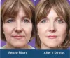 Dermal Fillers Treatment Delhi