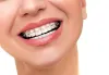 5 Common Questions You Should Know About Braces | What Are The Best Teeth Straightening Options To Improve Your Smile?