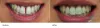 Orthodontic Braces | Dental Braces Penrith – Smile Dental