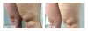 What are leg cramps and their treatments - veintreatmenttexas.over-blog.com