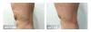 Treatments For Spider Veins In Houston