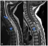 Symptoms Spinal Cancer