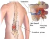 Spinal Disc Decompression treatment | Neck &amp; Back pain treatment