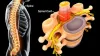 Advancements in Treatment of Acute Spinal Conditions