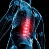 Types of Surgeries that utilize Implants of Spine