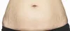 Best Laser Stretch Marks Removal Cost in Delhi, West Delhi, Janakpuri