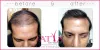 Artificial hair transplant and replacement procedure cost in India